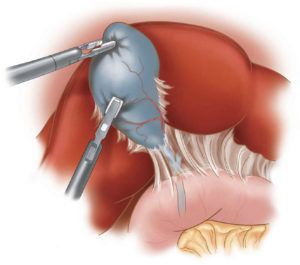 laparoscopia-colecistectomia