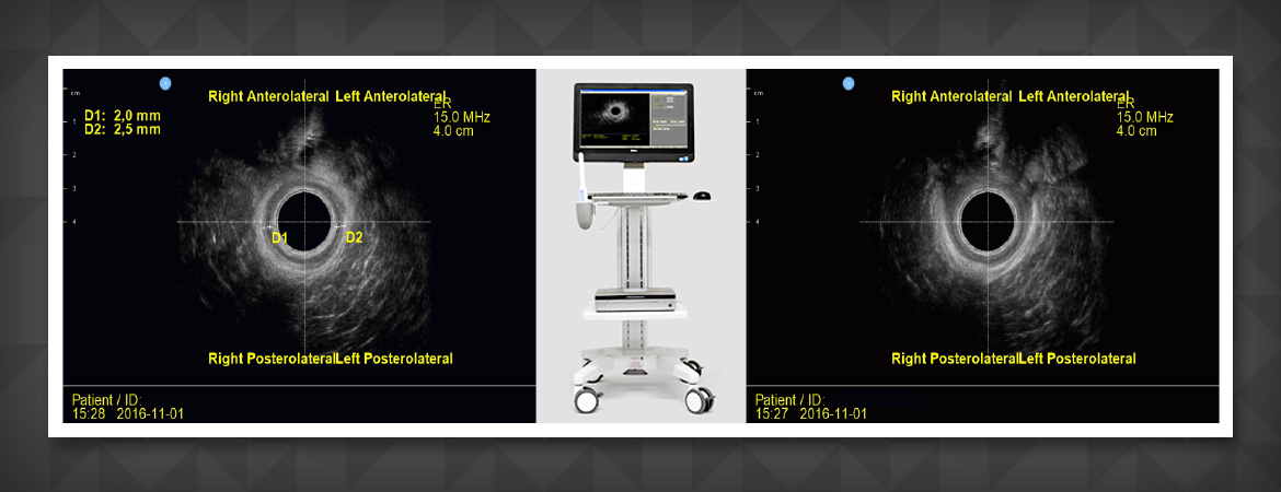 Ultrassonografia Anorretal